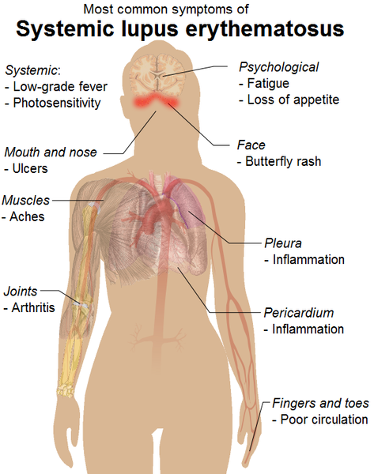 Common symptoms of Systemic Lupus Erythematosus 