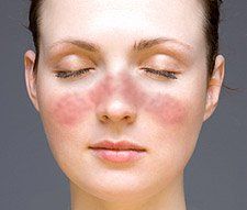Acute cutaneous lupus malar rash on face